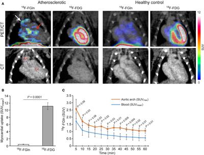 Exploiting Glutamine Consumption in Atherosclerotic Lesions by Positron Emission Tomography Tracer (2S,4R)-4-18F-Fluoroglutamine